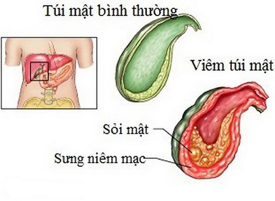 Khởi nguồn của sỏi túi mật là dịch mật.